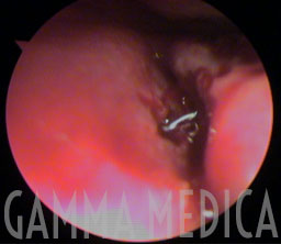 Osteotomia laser del dotto lacrimale Osteotomia laser del dotto lacrimale
