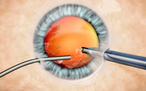 intervento di cataratta intervento di cataratta