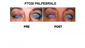 Ptosi Palpebrale