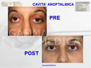 Cavità anoftalmica