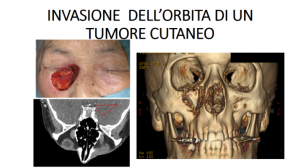 Invasione orbita tumore cutaneo