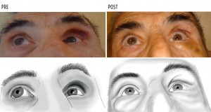 lipofilling dopo frattura del pavimento dell'orbita