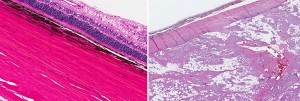 Meningioma dell'orbita