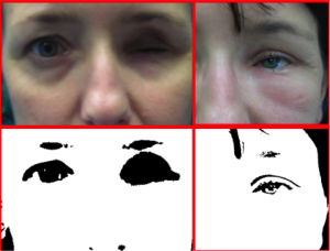 cavità anoftalmica retratta (enoftalmo estremo)