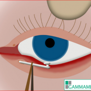 gammamedica_dcr_laser_vie_lacrimali Laser per le ostruzioni dulle vie lacrimali