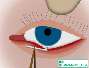 Laser per le ostruzioni dulle vie lacrimali